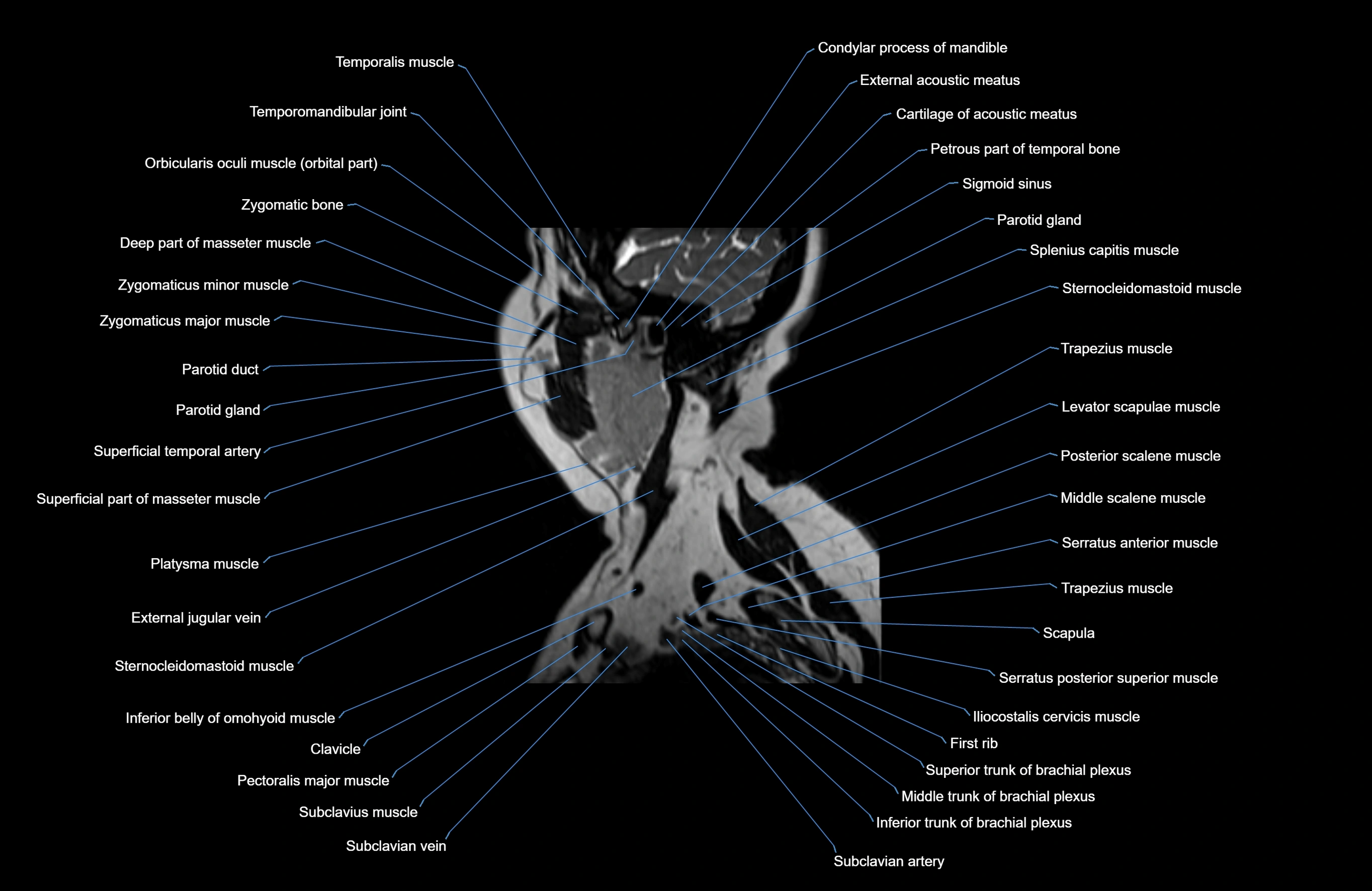 Neck MRI sagittal cross sectional anatomy 3D 1mm 3T radiology  image-img-00001-00034.webp
